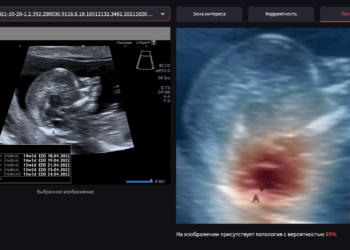 Нейросеть Яндекса помогает выявлять редкую патологию  на ранних сроках беременности